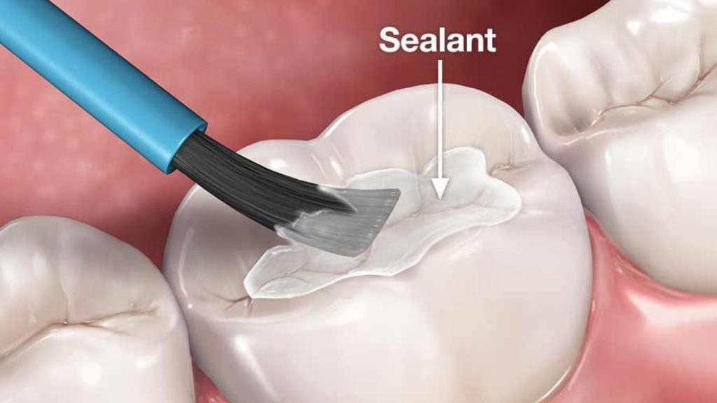 Fissure Sealant: The Key to Healthy Teeth