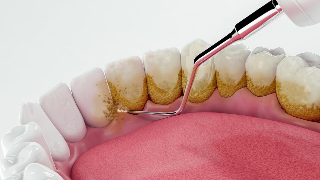 Teeth Scaling and Root Planing: Procedure, Benefits & Cost